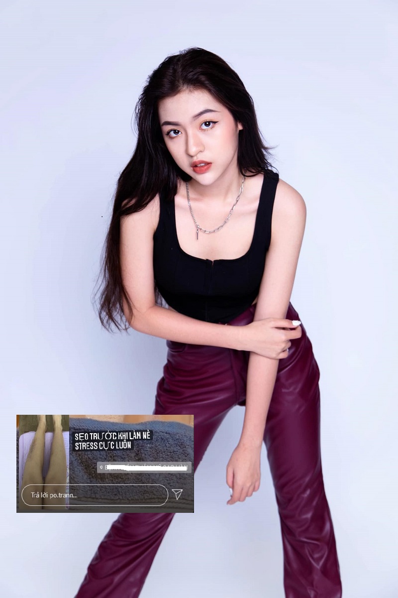 Hotgirl Trứng rán Trần Thị Thanh Tâm lên tiếng về sự cố dẫn đến chân bị thâm. Ảnh FBNV Hotgirl Trứng rán Trần Thị Thanh Tâm lên tiếng về sự cố dẫn đến chân bị thâm. Ảnh FBNV