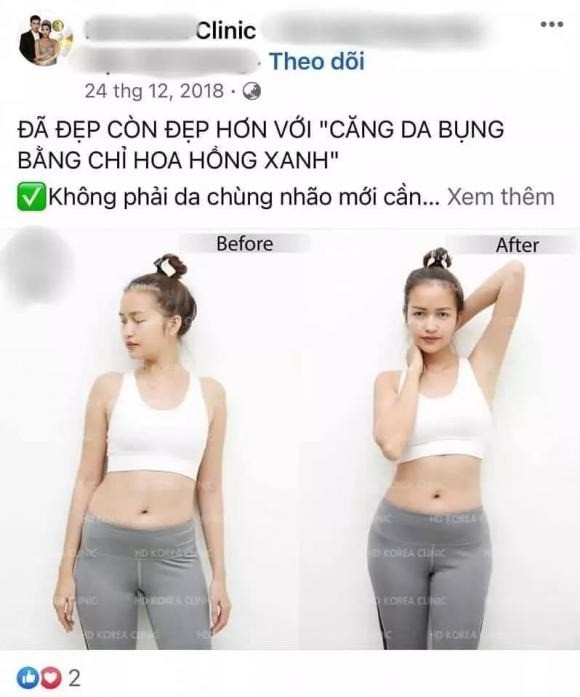 Xôn xao hình ảnh Ngọc Châu đi thẩm mỹ khuôn mặt và trùng tu da bụng. Ảnh: Internet