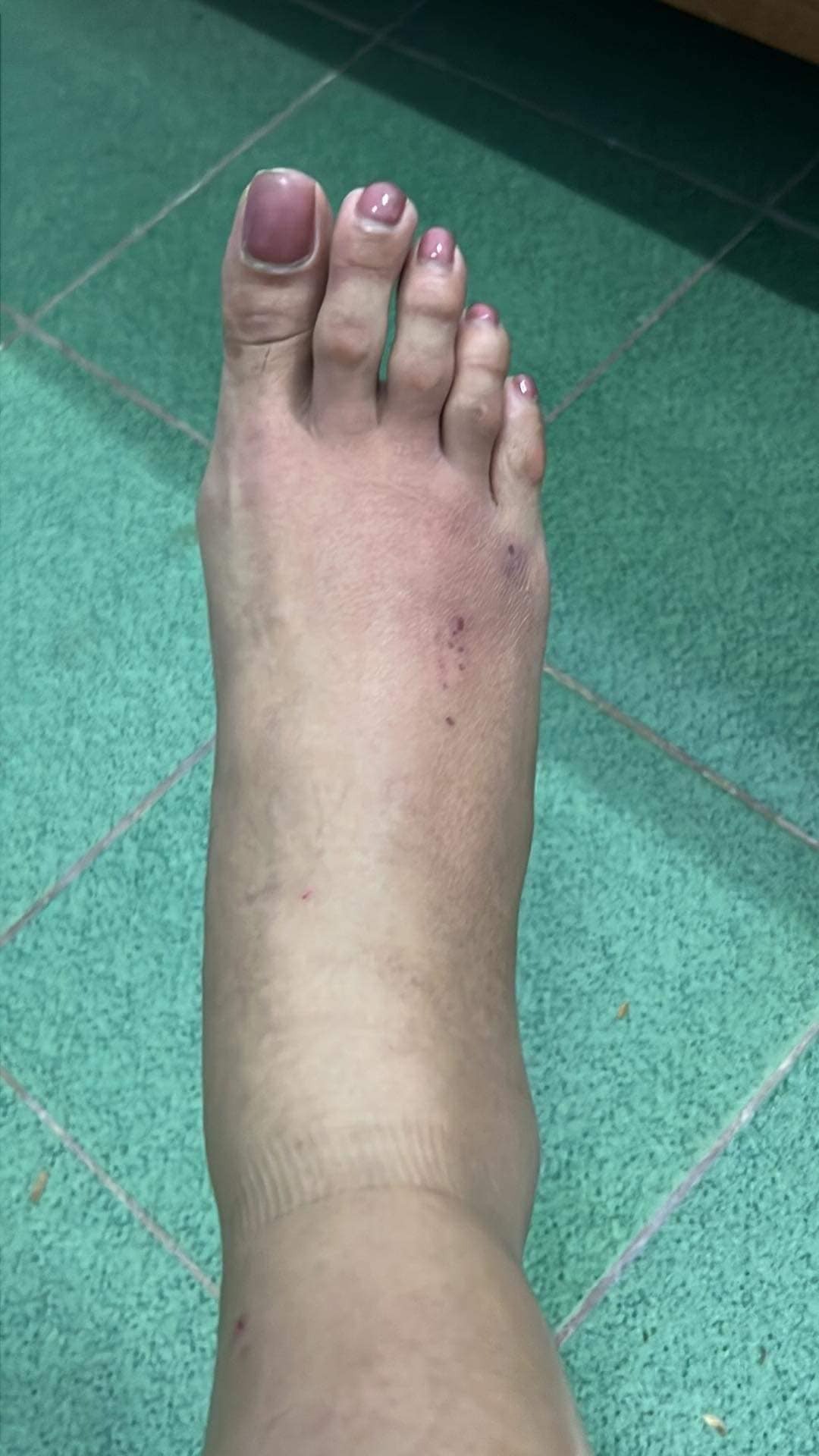 Võ Hoàng Yến tiết lộ tình trạng bất ổn của đôi chân 'bạc tỷ' khiến ai nấy xót xa - Ảnh 2