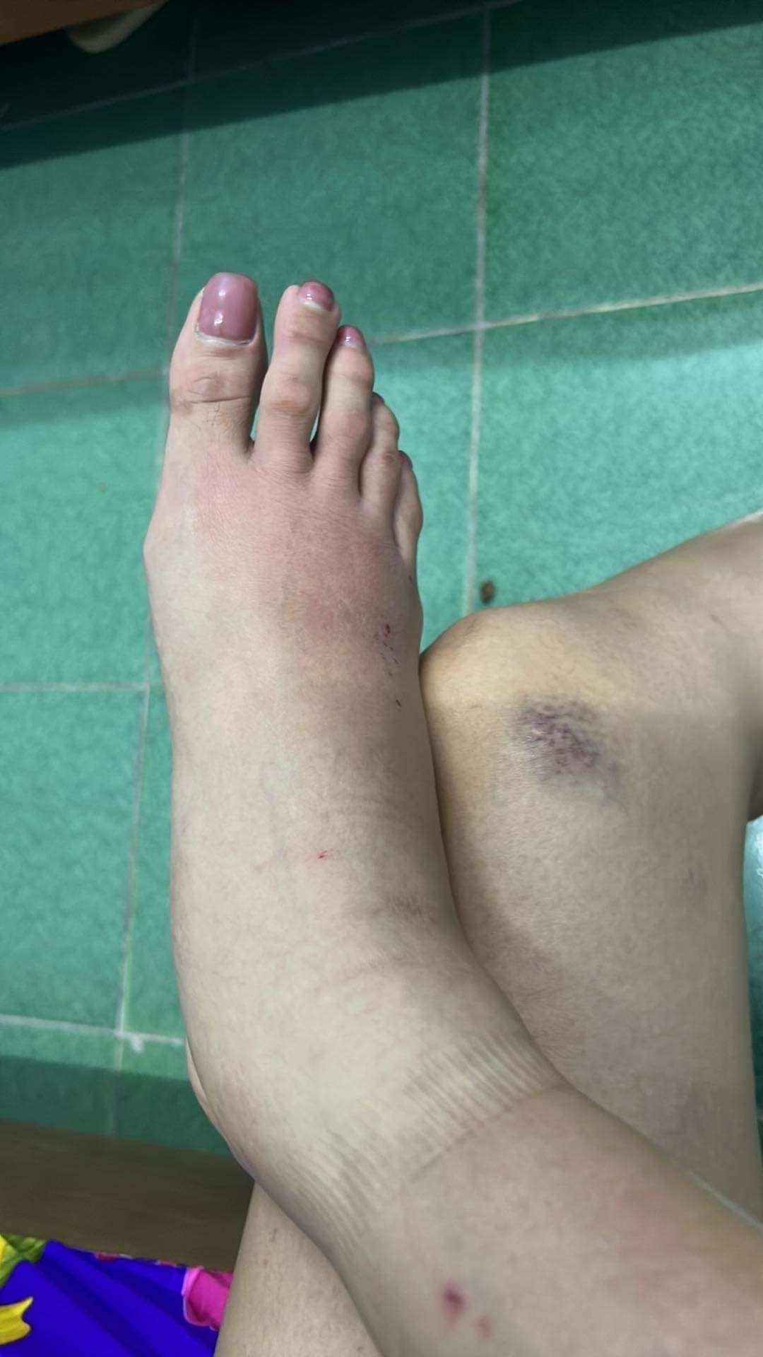 Võ Hoàng Yến tiết lộ tình trạng bất ổn của đôi chân 'bạc tỷ' khiến ai nấy xót xa - Ảnh 1