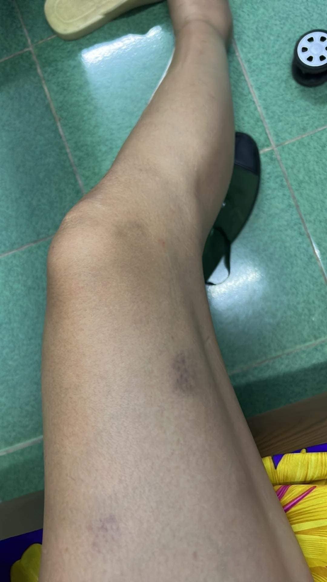 Võ Hoàng Yến với nhiều vết tím và cổ chân sưng. Ảnh: Internet