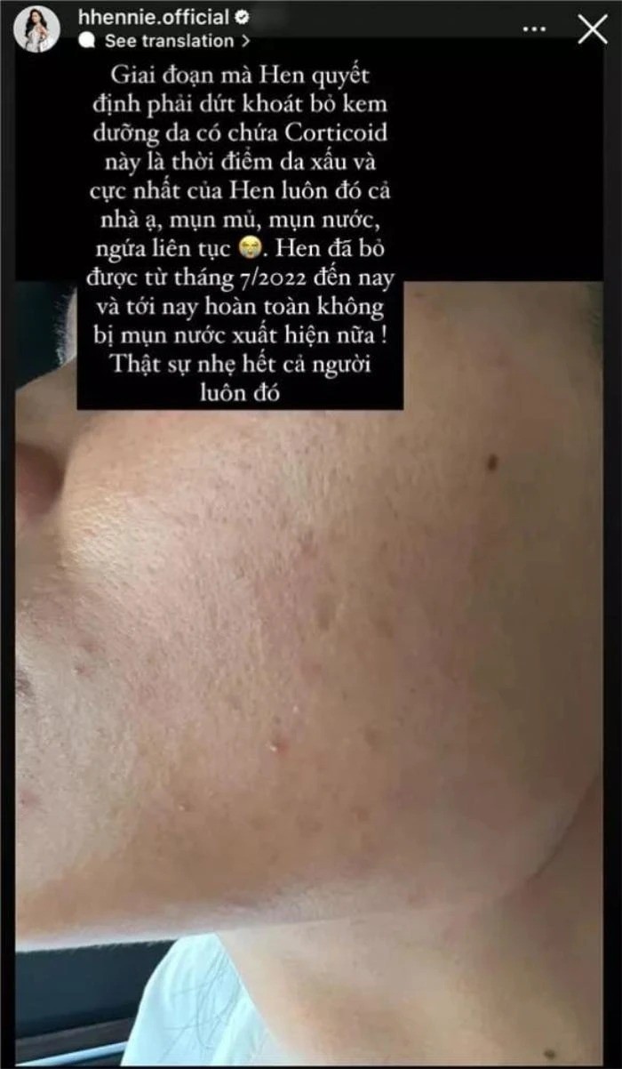 H'Hen Niê từng nhận phải hậu quả khi sử dụng kem trộn. Ảnh: FBNV