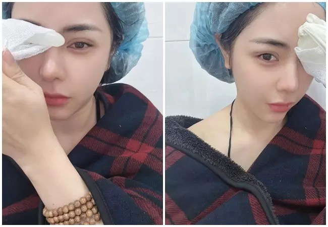 Ngoại hình bạn gái Huỳnh Anh sau khi nhấn mí. Ngoại hình bạn gái Huỳnh Anh sau khi nhấn mí.