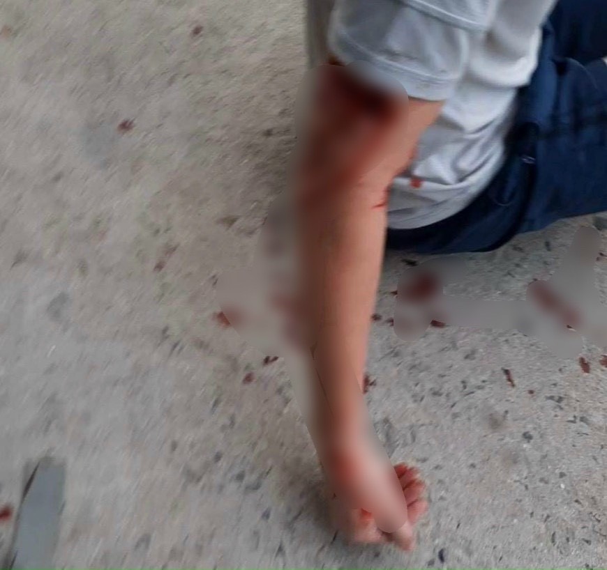 Du khách nước ngoài bị chó cắn bị thương. Ảnh: B.T.