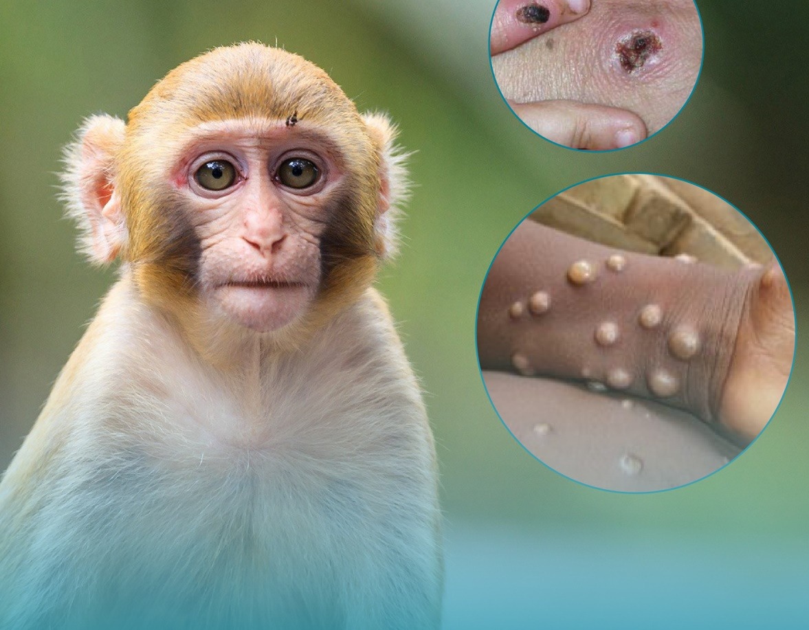 NÓNG: Hướng dẫn chẩn đoán, quy trình điều trị bệnh đậu mùa khỉ từ Bộ Y tế 