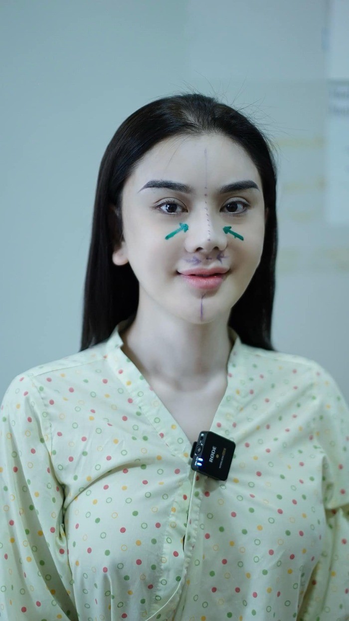 Lâm Khánh Chi quyết định đi trùng tu mũi (Ảnh: FBNV) Lâm Khánh Chi quyết định đi trùng tu mũi (Ảnh: FBNV)