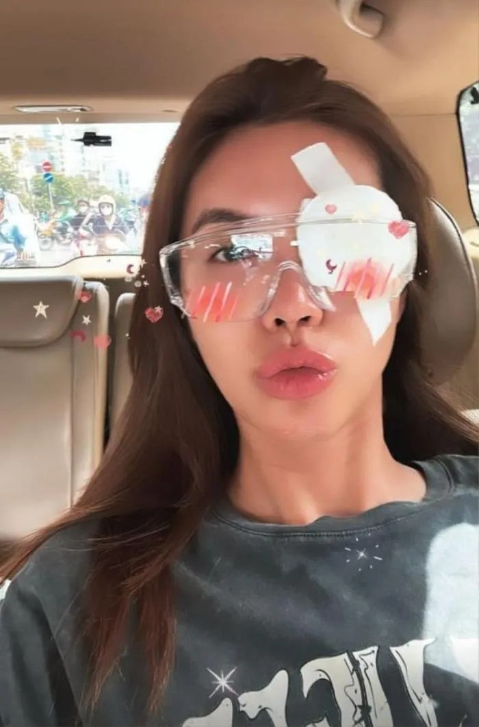 Minh Tú chia sẻ hình ảnh đôi mắt bị thương khiến nhiều khán giả lo lắng. Ảnh: FB Minh Tú. Minh Tú chia sẻ hình ảnh đôi mắt bị thương khiến nhiều khán giả lo lắng. Ảnh: FB Minh Tú.