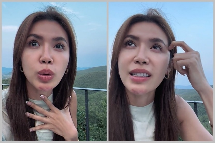Trước đó, cô cũng bị một tai nạn ở cằm. Ảnh: FB Minh Tú. Trước đó, cô cũng bị một tai nạn ở cằm. Ảnh: FB Minh Tú.
