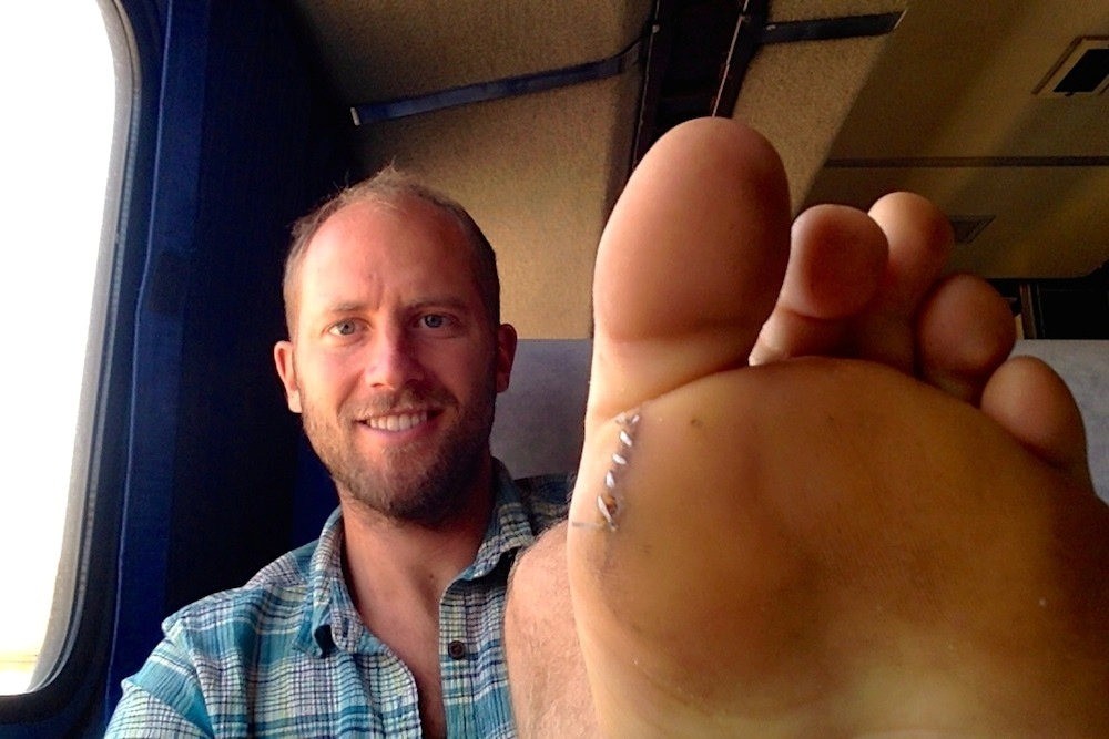 Người đàn ông 37 tuổi thỉnh thoảng bị thương ở bàn chân. Ảnh: New York Post