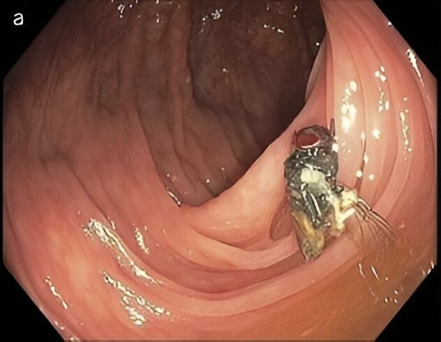 Cận cảnh con ruồi nằm trong ruột của bệnh nhân.
