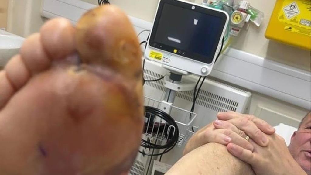 Dấu răng nanh của con nhện có thể được nhìn thấy trên ngón chân của Blake