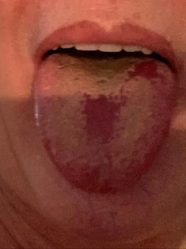 Nóng hay rộp lưỡi cũng là một trong dấu hiệu được phát hiện. Ảnh: The Sun