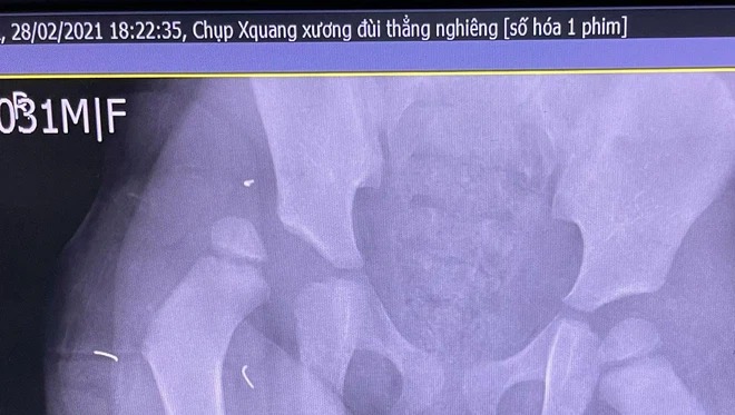 Hình ảnh khớp háng của bệnh nhi. Ảnh: BSCC Hình ảnh khớp háng của bệnh nhi. Ảnh: BSCC