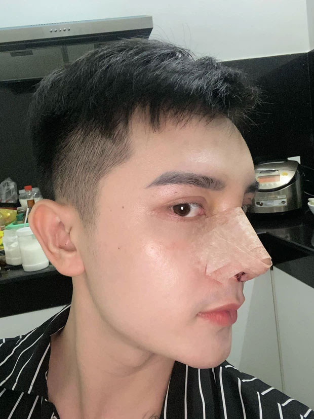 Quyền đã chi hơn 400 triệu đồng cho các ca phẫu thuật nâng mũi, độn cằm, làm răng sứ (Hà Nội); cắt môi, tiêm môi, tiêm bọng mắt, mở góc mắt (Sài Gòn). Ảnh: FB