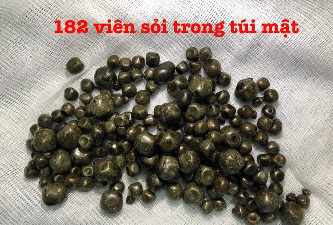 Một bệnh nhân ở Cần Thơ được các bác sĩ lấy ra gần 200 viên soi trong túi mất hồi năm 2018. Ảnh: BSCC Một bệnh nhân ở Cần Thơ được các bác sĩ lấy ra gần 200 viên soi trong túi mất hồi năm 2018. Ảnh: BSCC