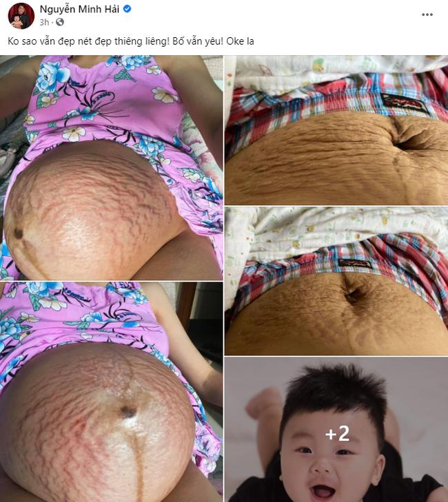Động thái của bạn trai Hoà Minzy khi nữ ca sĩ công khai bụng nát tươm sau 2 năm sinh nở 2 Động thái của bạn trai Hoà Minzy khi nữ ca sĩ công khai bụng nát tươm sau 2 năm sinh nở 2