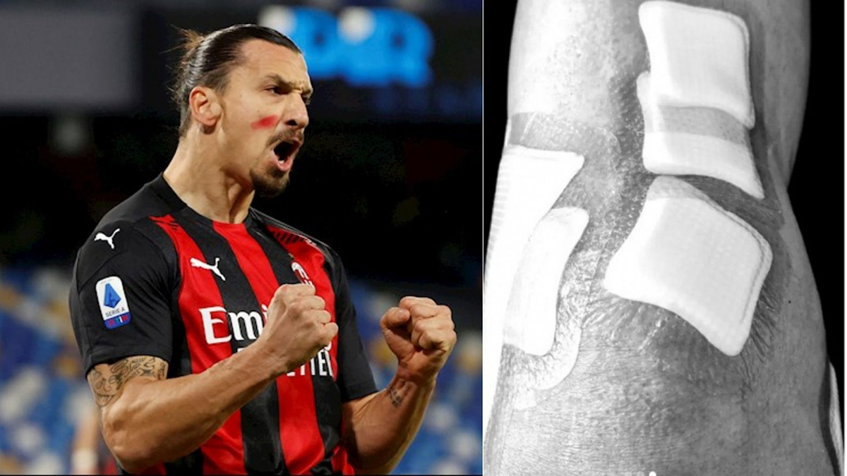 Tiền đạo Ibrahimovic thi đấu trong tình trạng đầu gối không có dây chằng. Ảnh: Internet