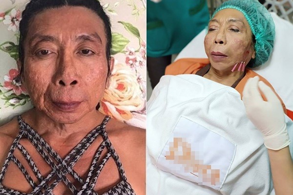 Nhiều người cho rằng đó là hệ quả của việc người phụ nữ này lạm dụng thẩm mỹ (ảnh internet) Nhiều người cho rằng đó là hệ quả của việc người phụ nữ này lạm dụng thẩm mỹ (ảnh internet)