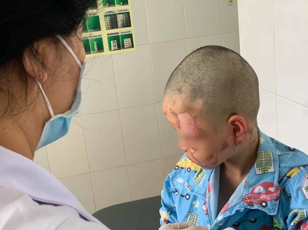 Tình trạng điều trị hiện tại của em H. Ảnh: BVCC Tình trạng điều trị hiện tại của em H. Ảnh: BVCC