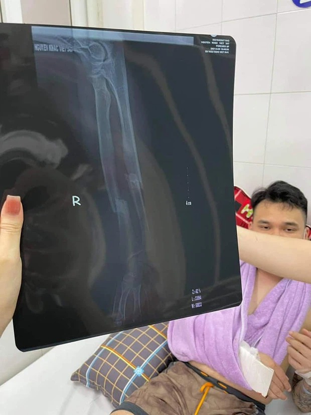 Phim chụp X-quang tình trạng chấn thương của Khắc Việt. Ảnh: FB Phim chụp X-quang tình trạng chấn thương của Khắc Việt. Ảnh: FB
