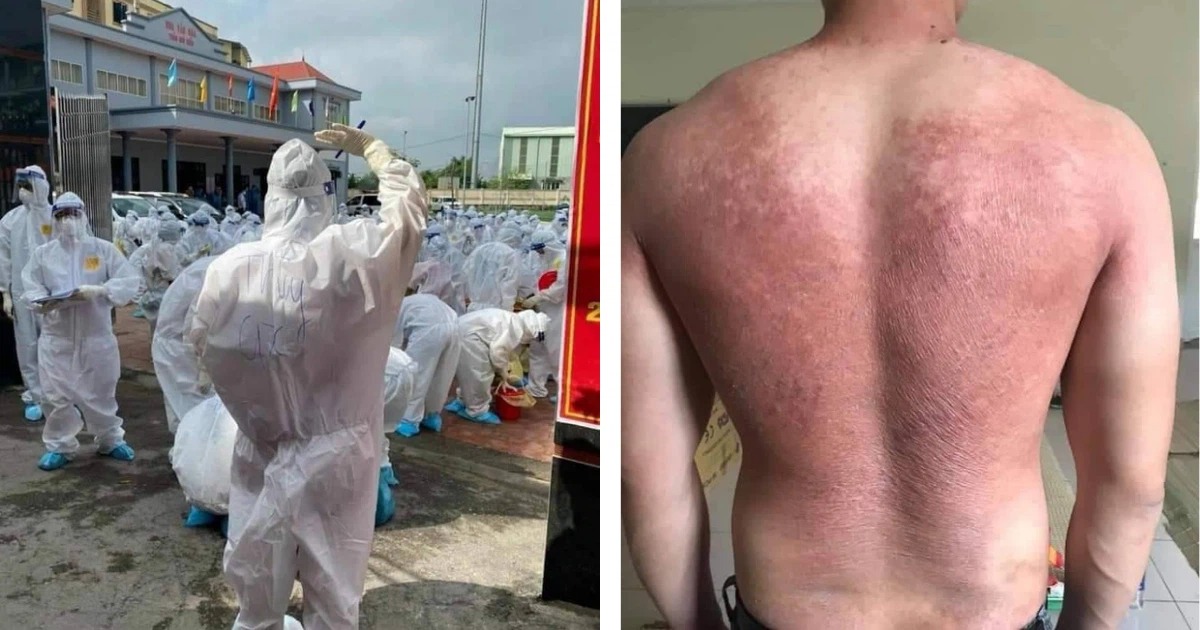 Vết cháy nắng dưới nhiệt độ gay gắt của thời tiết miền Bắc vào hè. Ảnh: FB Vết cháy nắng dưới nhiệt độ gay gắt của thời tiết miền Bắc vào hè. Ảnh: FB