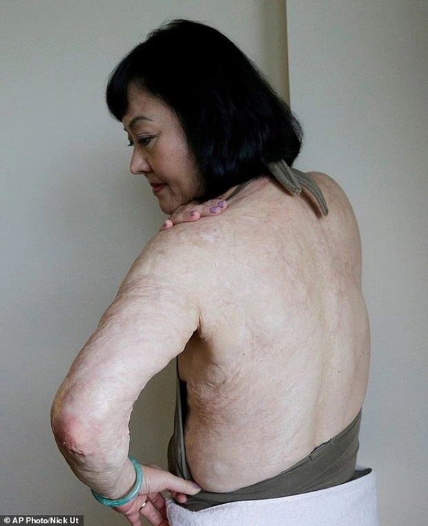 Bất ngờ cuộc sống hiện tại của 'Em bé Napalm' từng gây chấn động cả thế giới 5 Bất ngờ cuộc sống hiện tại của 'Em bé Napalm' từng gây chấn động cả thế giới 5