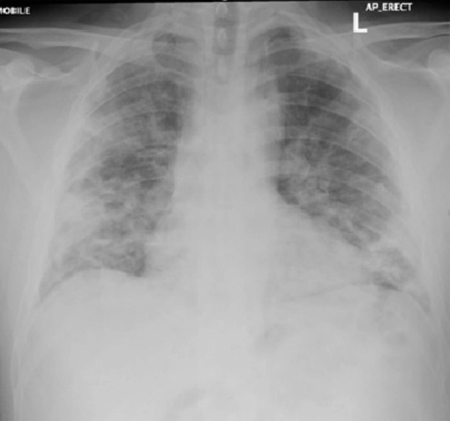 Muốn biết Covid-19 đã ‘phá’ sức khỏe bạn thế nào? Hãy nhìn vào phổi của ca bệnh trẻ 1