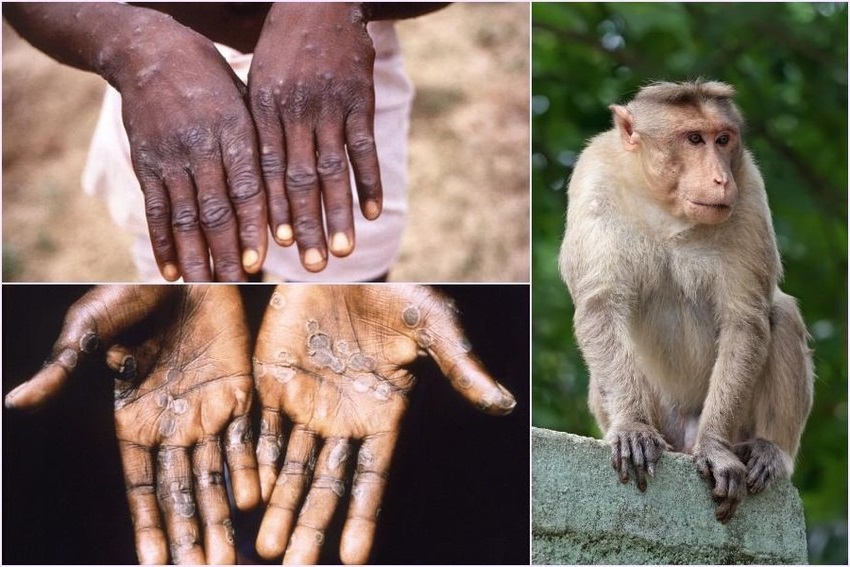 Bệnh đậu mùa khỉ đang hoành hành tại nhiều quốc gia trên thế giới.