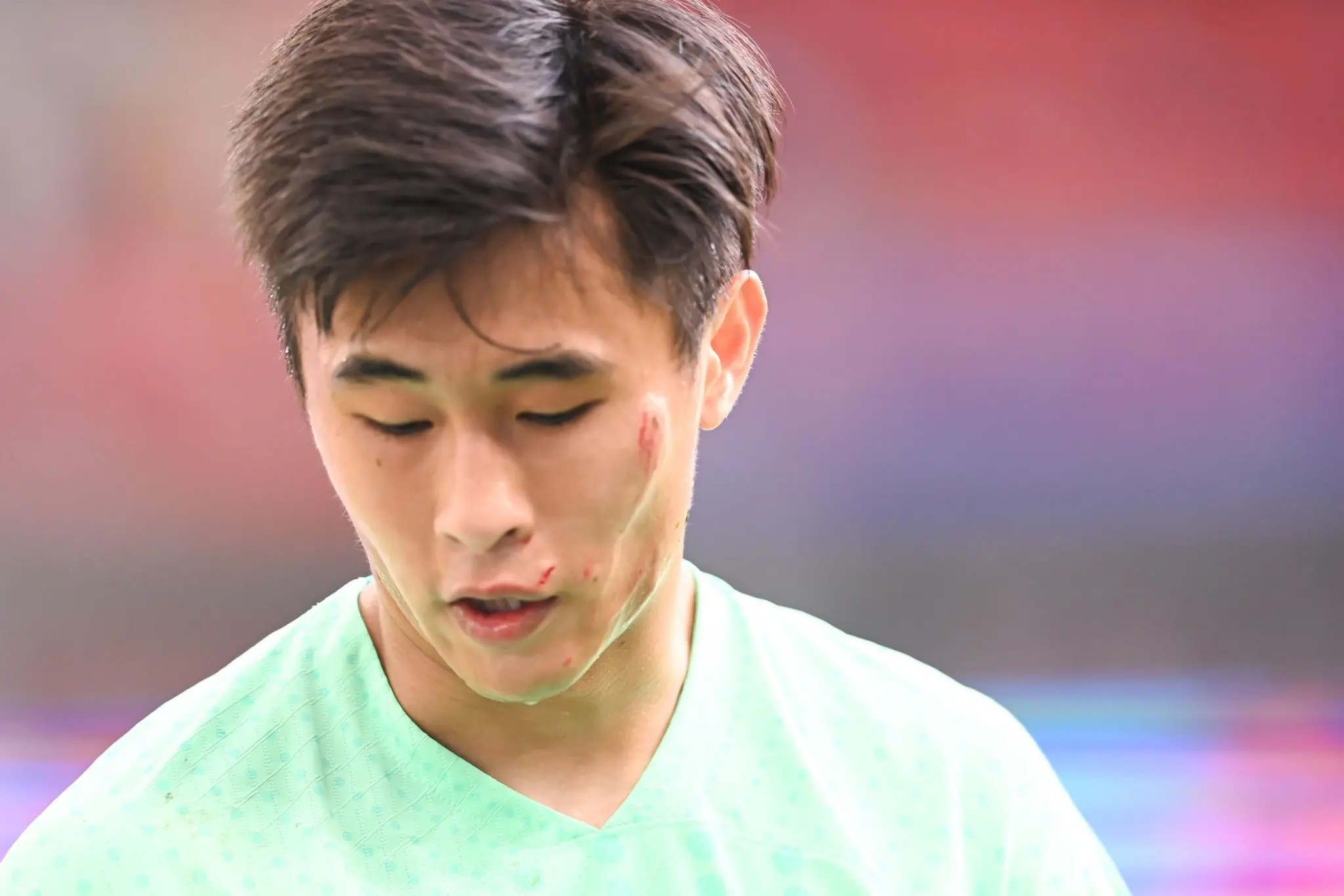 Khuôn mặt bị trầy xước của Dai Wai Tsun. Ảnh: Internet