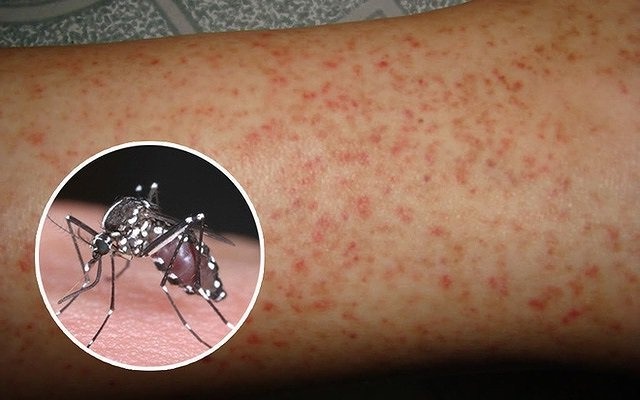 TP.HCM: Bệnh sốt xuất huyết có diễn biến ngày càng phức tạp - Ảnh 2