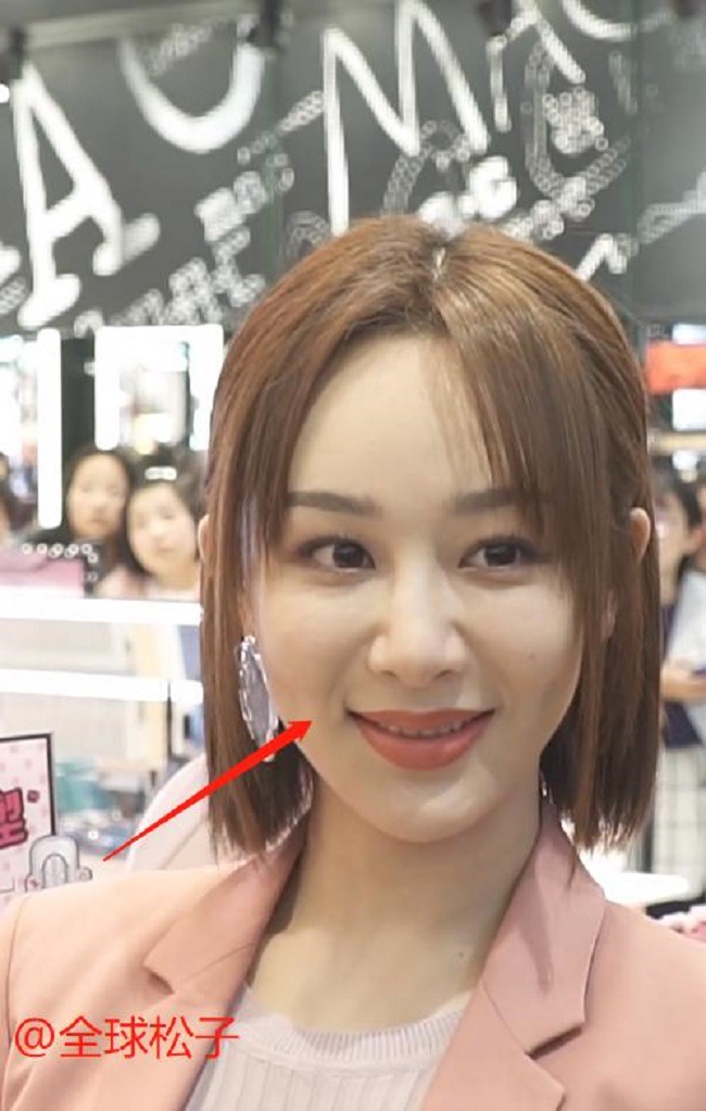 Trước đó, Dương Tử cũng từng xuất hiện với gương mặt sưng, đơ.