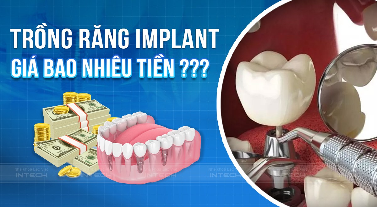  Chi phí trồng răng Implant hiện nay là bao nhiêu?