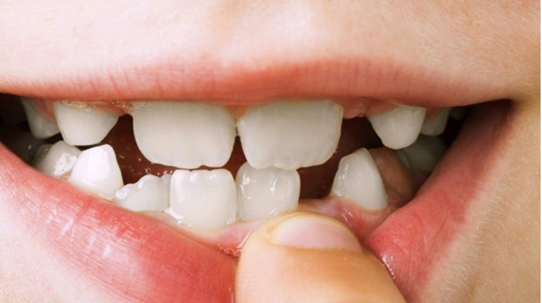 Răng thưa, khấp khểnh thì dễ nói bừa, nói phét, ăn nói không khéo và làm tổn thương hoặc xúc phạm người khác. Ảnh minh họa: Internet