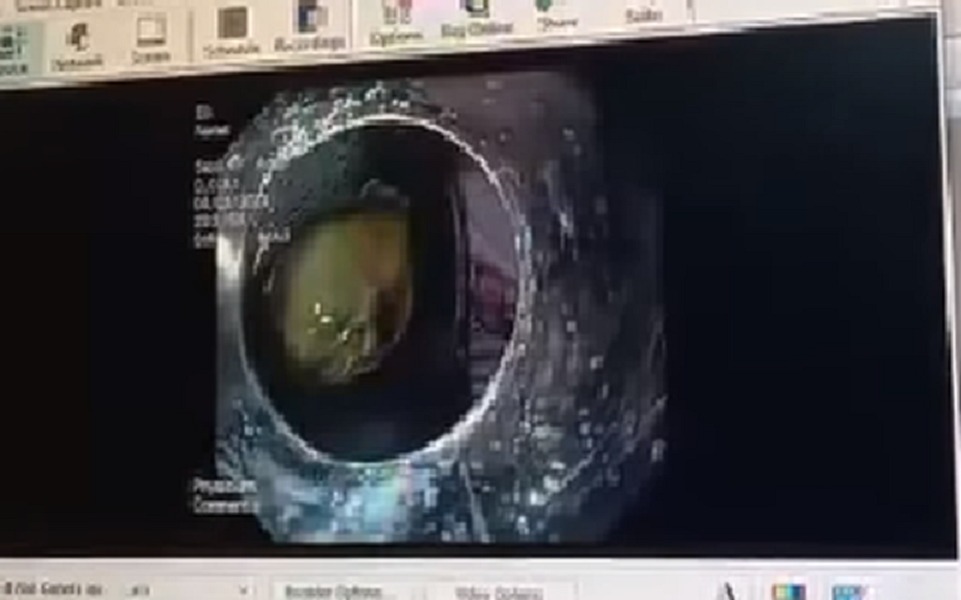 Hình ảnh túi mật bên trong thực quản bệnh nhân. Ảnh: BVCC