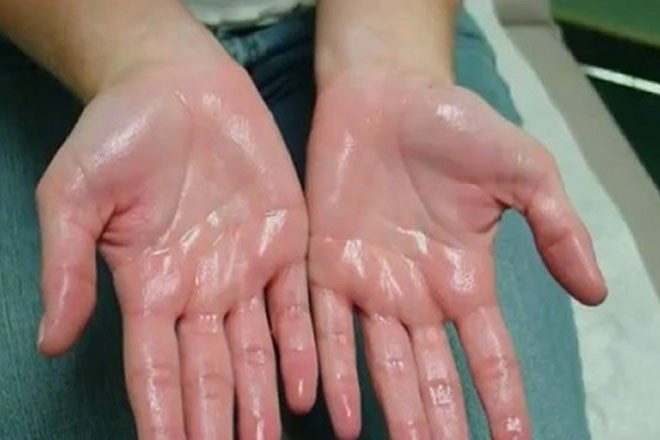 Đổ mồ hôi cục bộ thường không do nắng nóng mà do bệnh lý gây ra. Ảnh minh họa: Internet