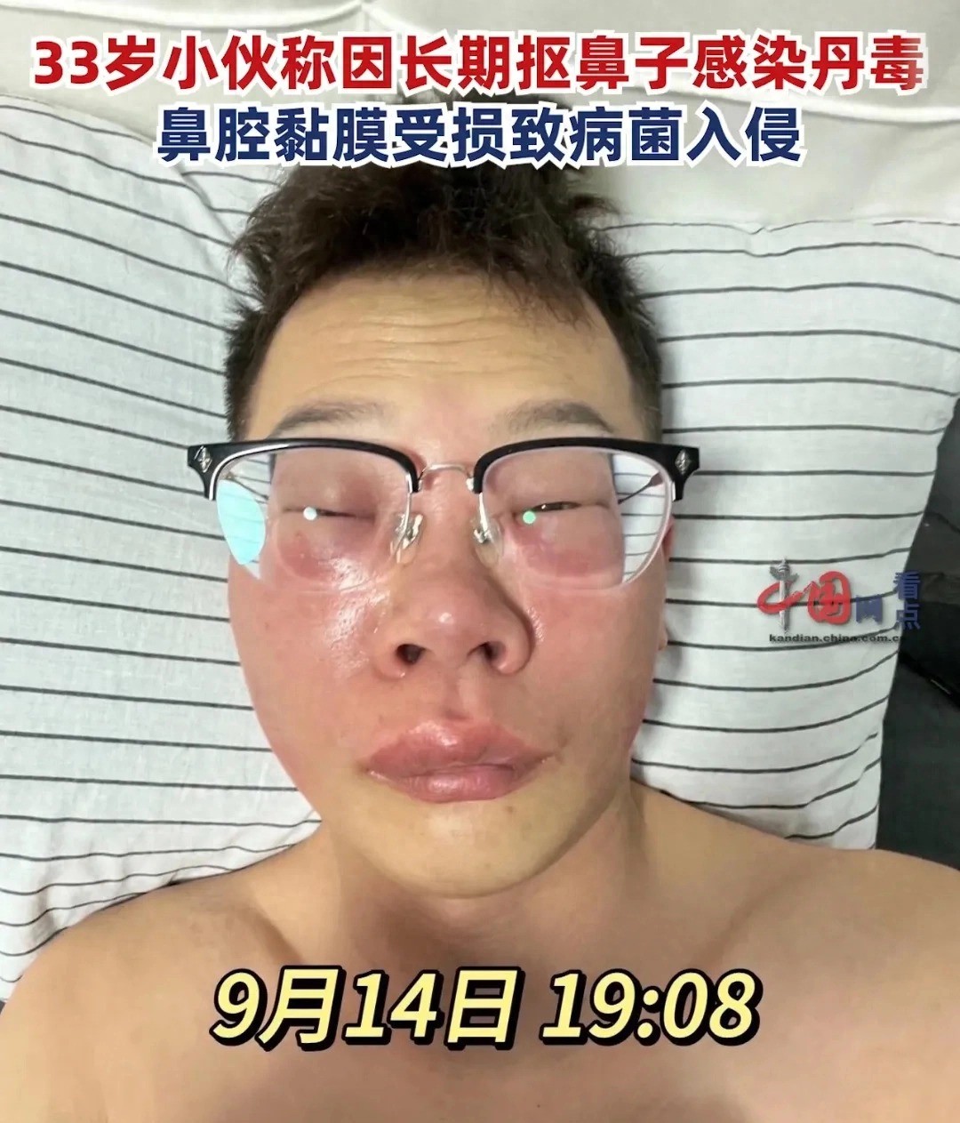 Mắt, mũi, miệng của người đàn ông sưng húp híp. Ảnh: Internet