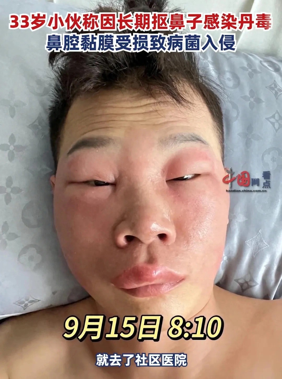 Ban đầu, bệnh viện chẩn đoán nhầm anh ta bị viêm amidan. Ảnh: Internet