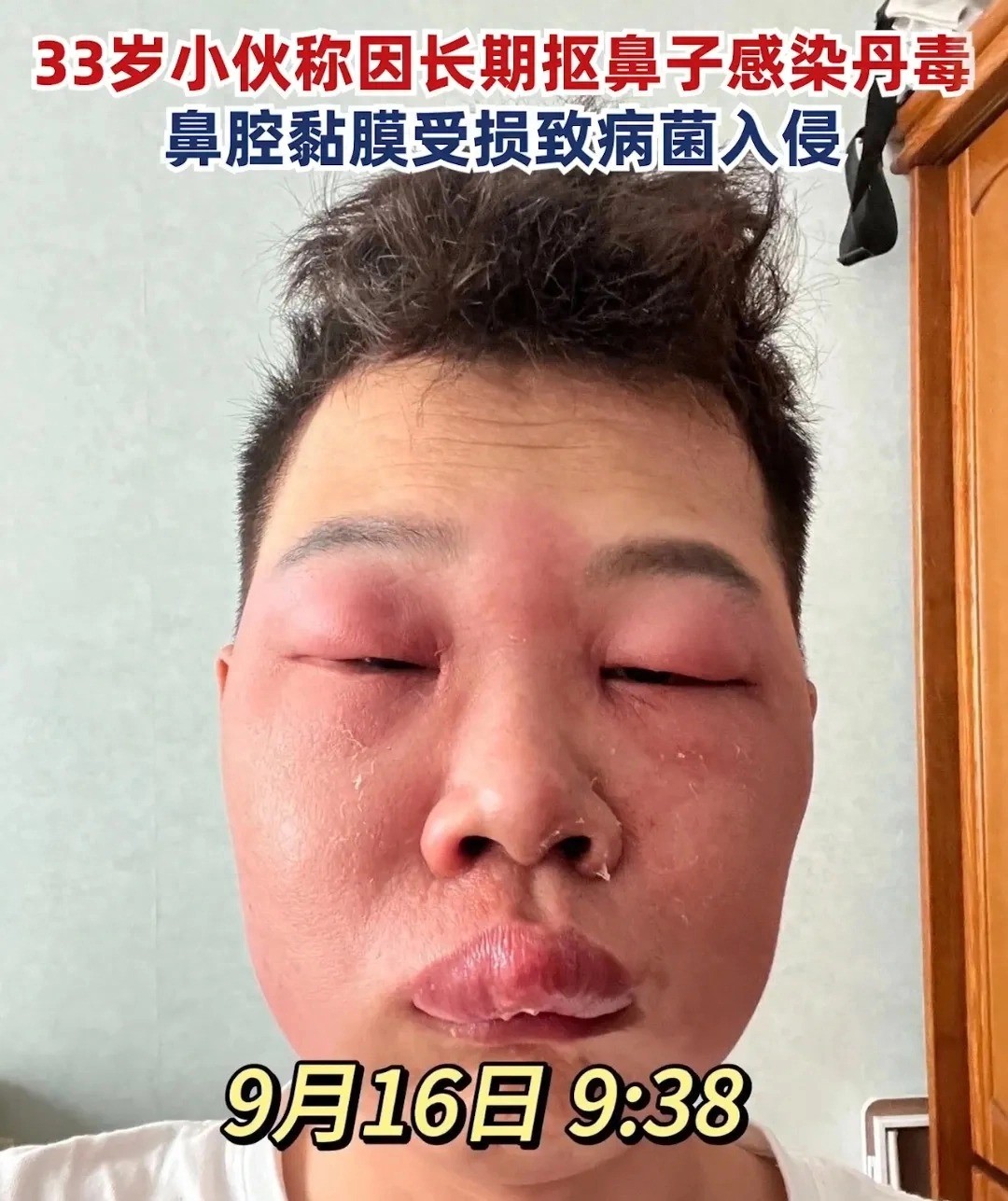 Nhưng sau đó, bác sĩ kết luận hành động ngoáy mũi kết hợp táo bón lâu ngày là nguyên nhân thật phía sau. Ảnh: Internet