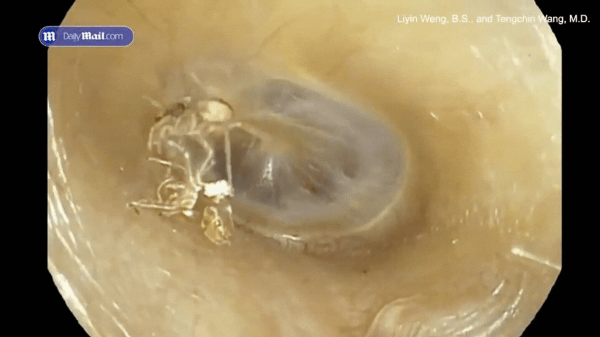 4 đêm nghe thấy tiếng xào xạc, lách cách trong tai, người phụ nữ đi khám thì tá hỏa khi biết sự thật