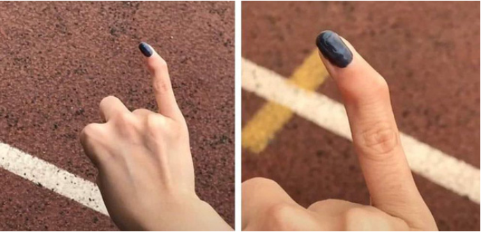 Bàn tay biến dạng vì cầm điện thoại sai cách