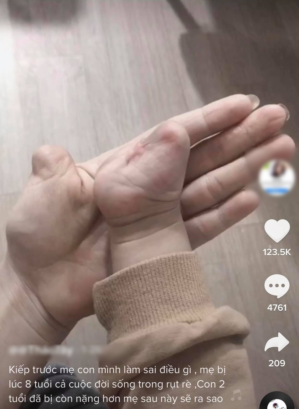 Cặp mẹ con có đôi tay khiếm khuyết đang nhận được sự quan tâm từ mọi người. (Ảnh: Chụp màn hình)