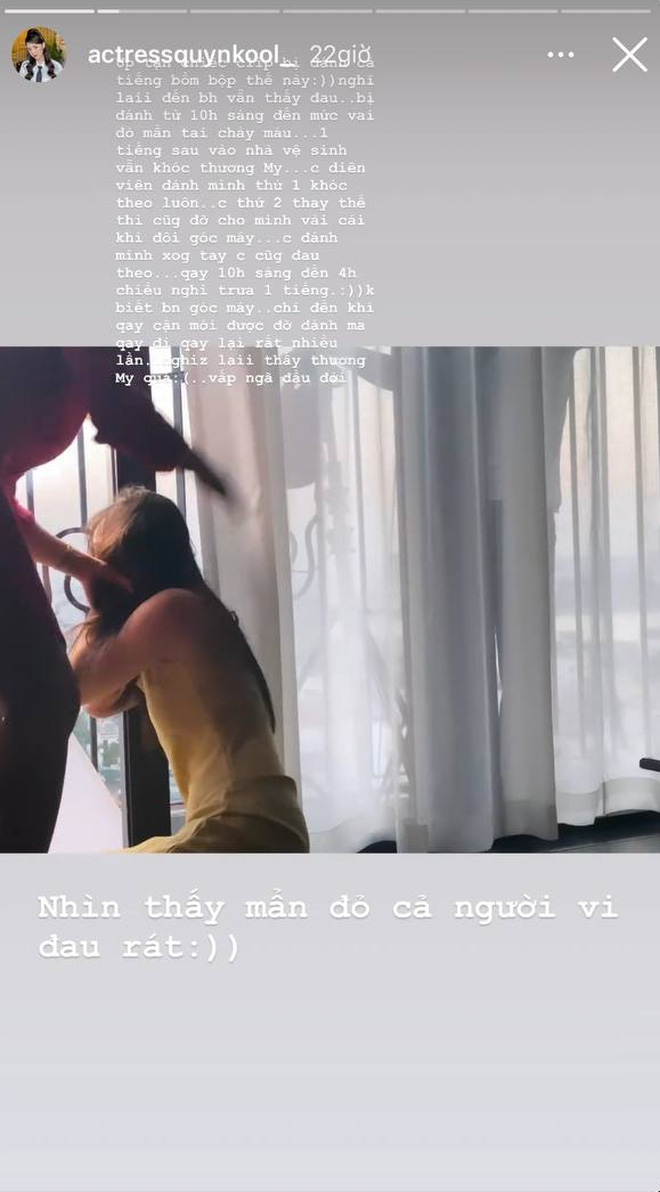 Quỳnh Kool bất ngờ đăng ảnh bị đánh bầm dập, dân tình hốt hoảng chuyện gì đây? - Ảnh 1
