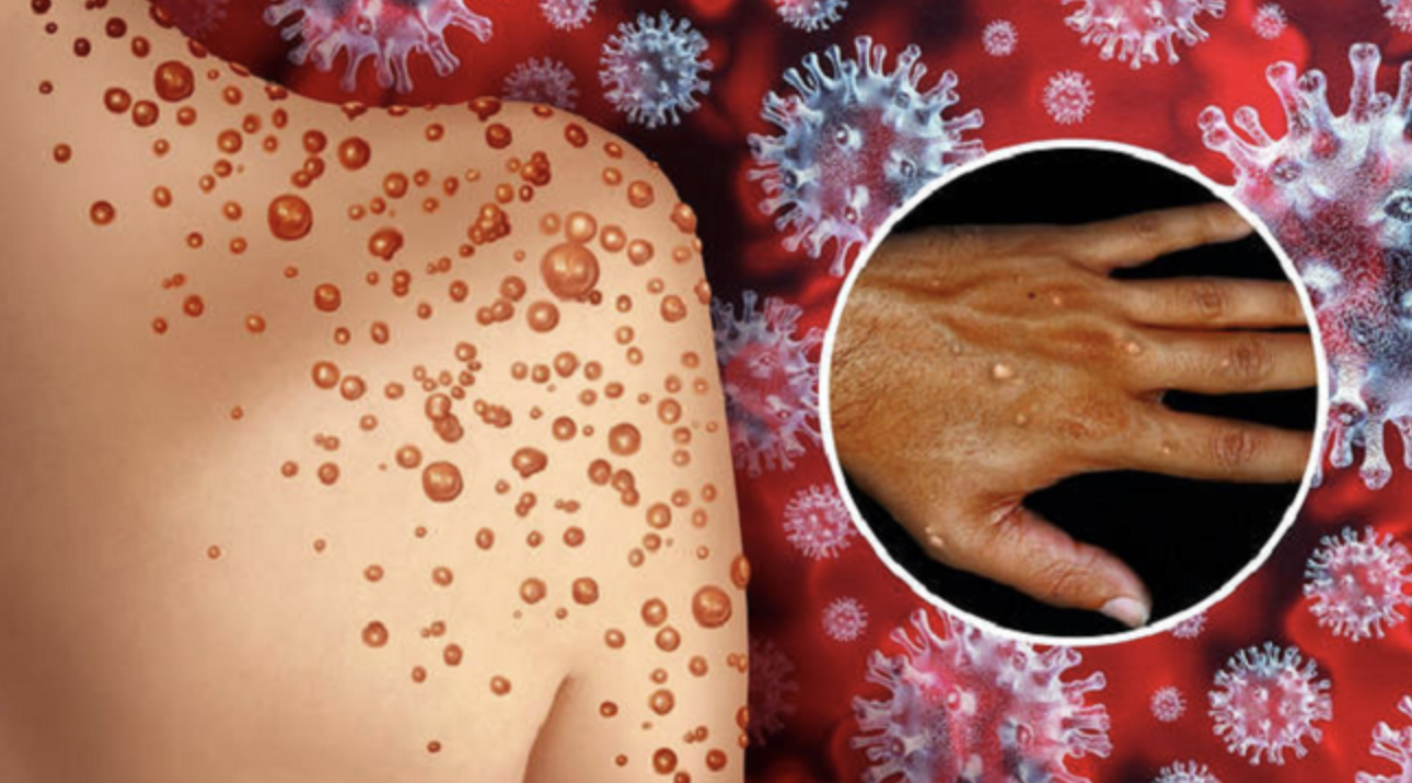 WHO công bố tên 2 biến chủng đậu mùa khỉ đang lưu hành. Ảnh: Internet