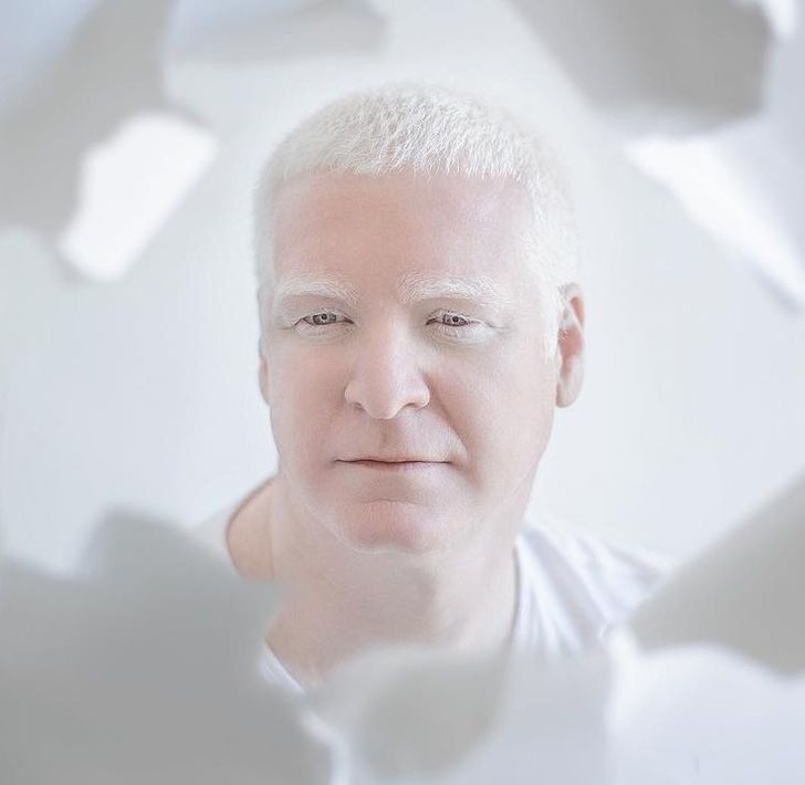 Nhiều người bạch tạng tự ti về ngoại hình của mình.