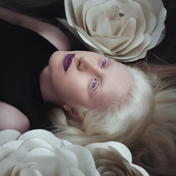 Đa phần những người mắc bệnh bạch tạng thường có làn da hồng và màu tóc trắng.