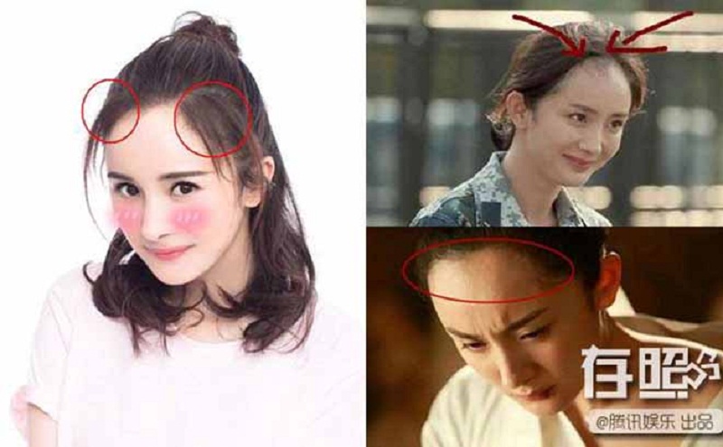 Ngoài ra, Dương Mịch còn bị hói đầu. Vầng trán dô cộng thêm hói khiến các stylist khá vất vả khi tạo hình cho Dương Mịch trong các phim cổ trang. Bạn có thể nhận ra điều này khi Dương Mịch giả trai trong Tam Sinh Tam Thế Thập Lý Đào Hoa.