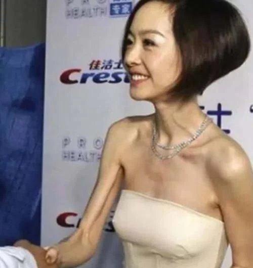 Lu Yu là một nữ MC nổi tiếng của Hoa ngữ. Bên cạnh tài năng thì người ta bị ám ảnh bởi thân hình quá gầy của cô. Lúc chụp ảnh, Lu Yu gầy tới mức nổi toàn bộ khung xương, trông vừa đáng sợ lại vừa xót xa.