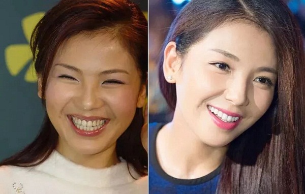 Trước đây, răng của Lưu Đào khá ổn, đều như hạt lựu và chỉ có khuyết điểm duy nhất là không trắng sáng, hơi thưa một xíu. Đến khi làm răng sứ, Lưu Đào lại chọn màu răng quá trắng, lệch hẳn với tông da của cô, gây ra cảm giác trắng giả tạo. Bản thân hàm răng sứ mới dày hơn răng cũ nên cũng cản trở việc phát âm của Lưu Đào. Nghe nói người đẹp còn chọn loại răng đắt đỏ, trong khi tuổi thọ cũng chỉ khoảng 15 năm. Điều này càng khiến Lưu Đào hối hận hơn nữa.