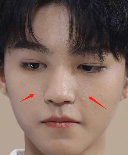 Vương Tuấn Khải được đánh giá là người chăm sóc da tốt nhất trong TFBoys nhưng trong một số bức ảnh chưa chỉnh sửa, CDM vẫn soi ra được lỗ chân lông to và những vết mụn.