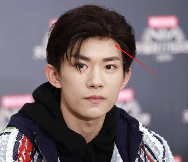 Dịch Dương Thiên Tử và Vương Nguyên đều bị mụn nhưng Thiên Tỉ nhẹ hơn. Ở vùng khóe miệng và cằm của anh chàng, chúng ta có thể nhìn thấy vài vết mụn. Sau khi trang điểm, tình hình này được cải thiện đáng kể.